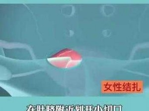 女性输卵管结扎术——一种安全长效的避孕方法