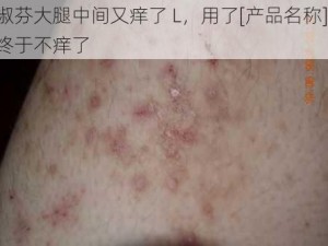 淑芬大腿中间又痒了 L，用了[产品名称]，终于不痒了