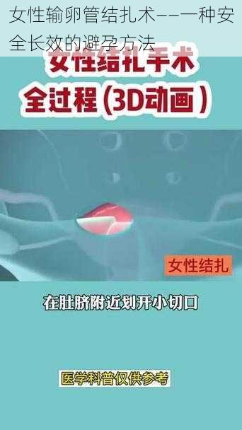 女性输卵管结扎术——一种安全长效的避孕方法