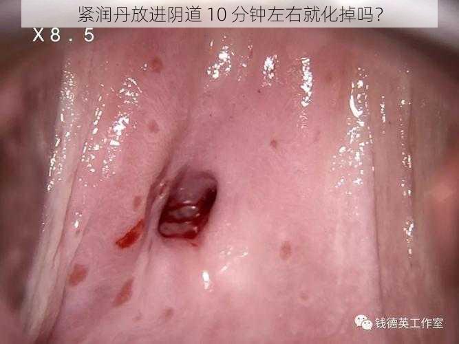 紧润丹放进阴道 10 分钟左右就化掉吗？