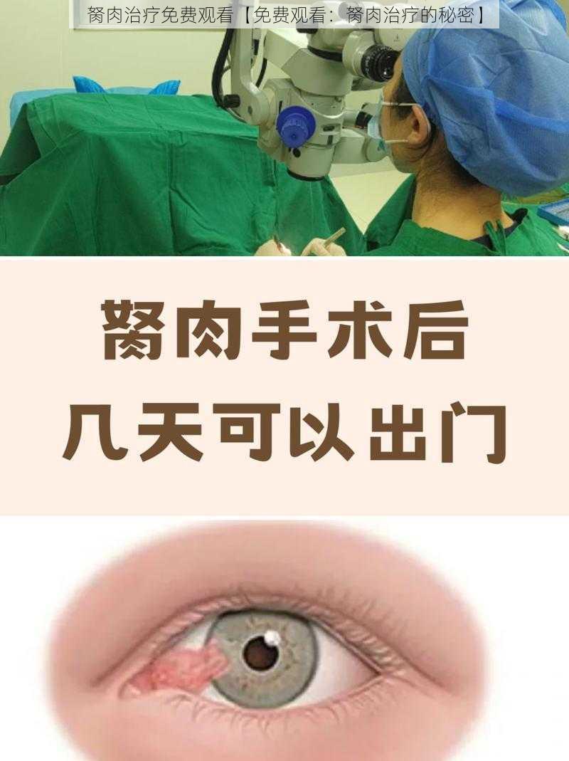 胬肉治疗免费观看【免费观看：胬肉治疗的秘密】